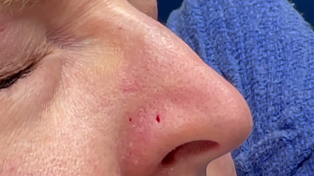 Vein Treatments (Sclerotherapy)