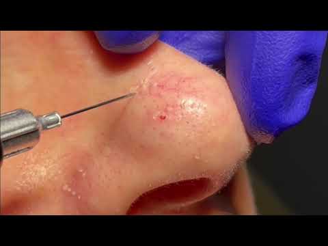 Vein Treatments (Sclerotherapy) 3