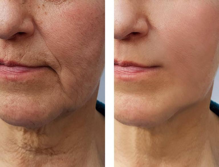 Microneedling – Jacksonville Dermatology & Cosmetic Surgery