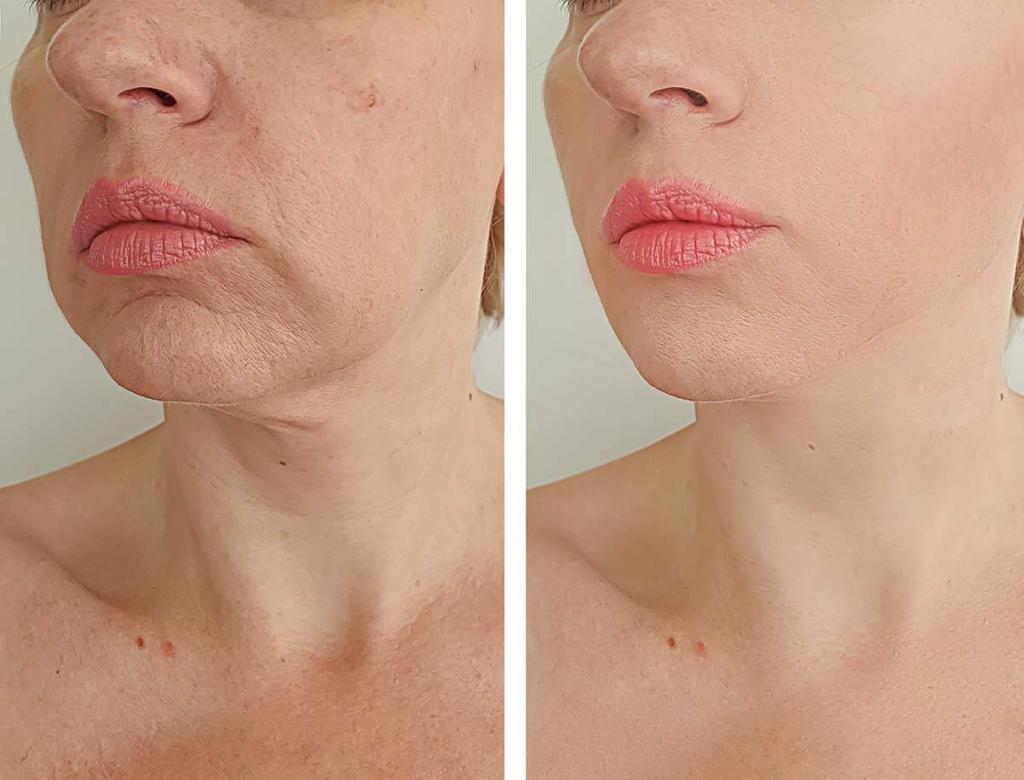 before and after microneedling        <h3 class=