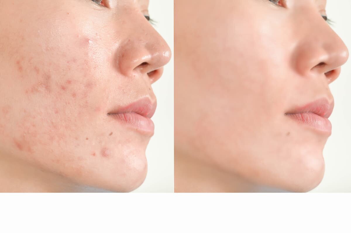 Acne Treatment Jacksonville – How to get rid of Acne?