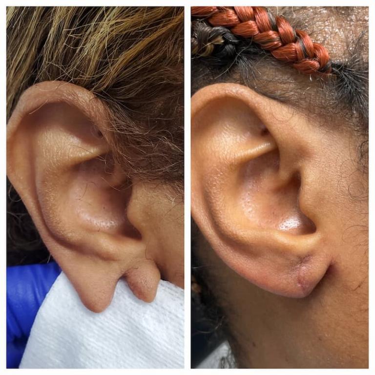 Otoplasty Jacksonville Ear Plastic Surgery Jacksonville Ear Reduction Surgery