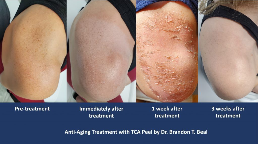 Chemical Peel Jacksonville – Chemical Peel for Acne Scars