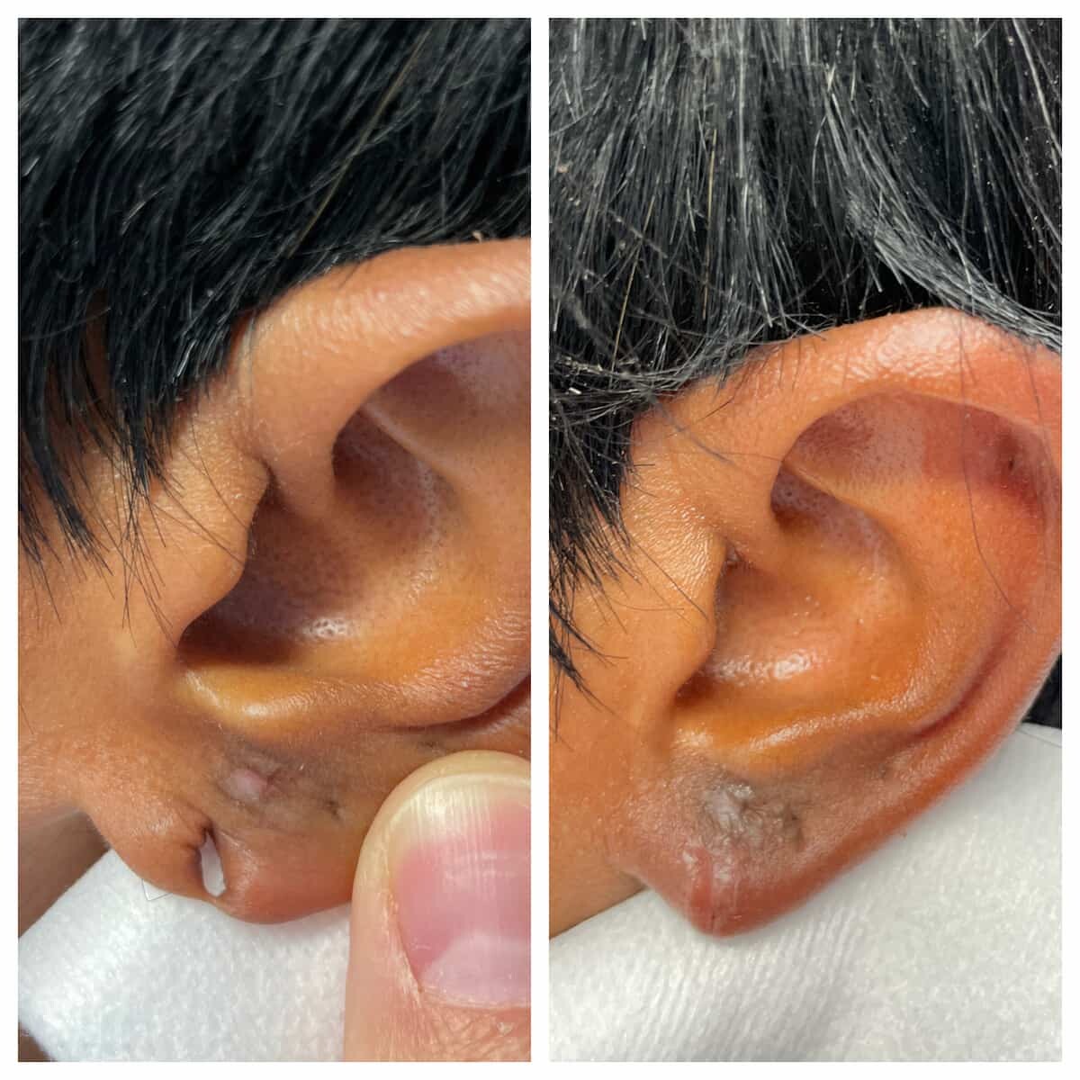 Poonam Sharma - ear hole repair clinic - auroplasty clinic | LinkedIn