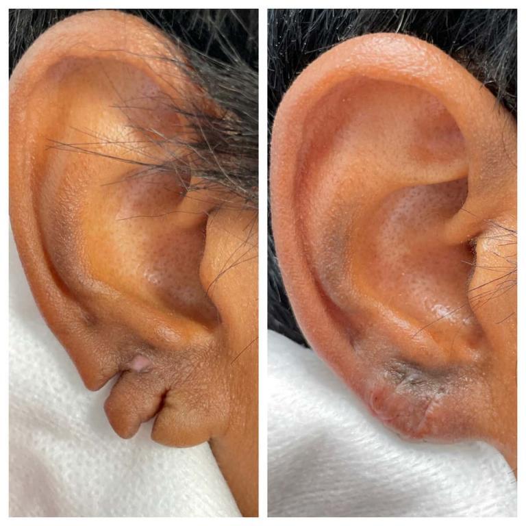 Otoplasty Jacksonville Ear Plastic Surgery Jacksonville Ear