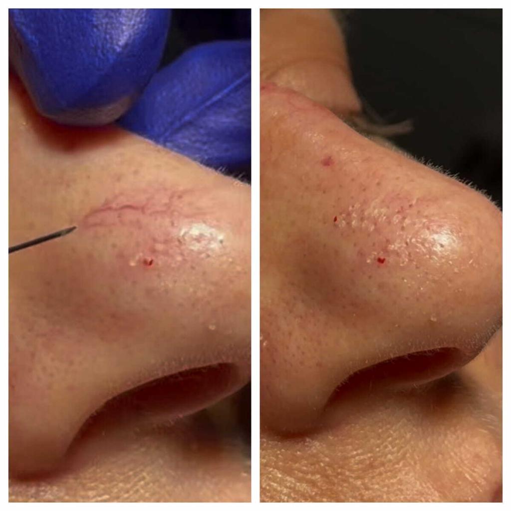 Spider Vein Removal New Haven - Using Injection Sclerotherapy