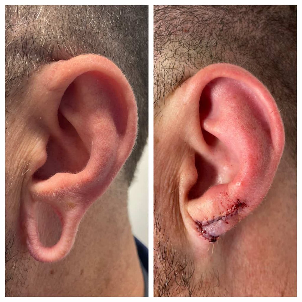 Polaris - Ear Lobe Repair
