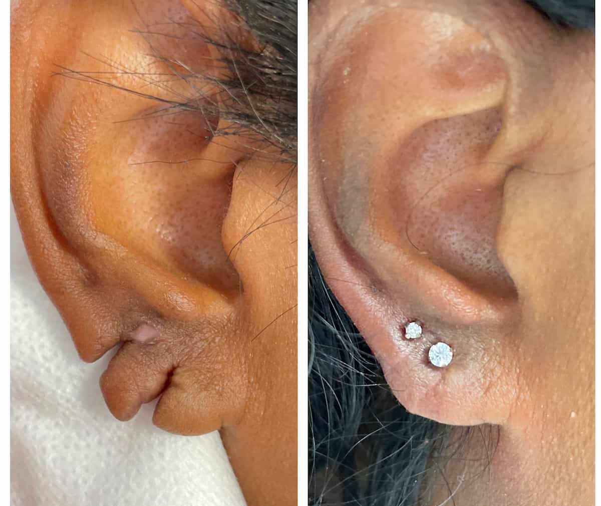 Polaris - Ear Lobe Repair