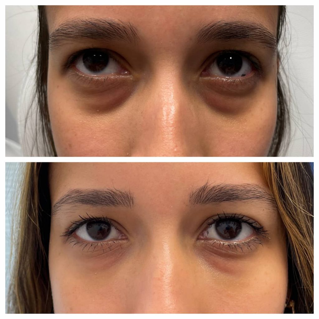 eyelid-lift-without-surgery-non-surgical-eyelid-lift-jacksonville