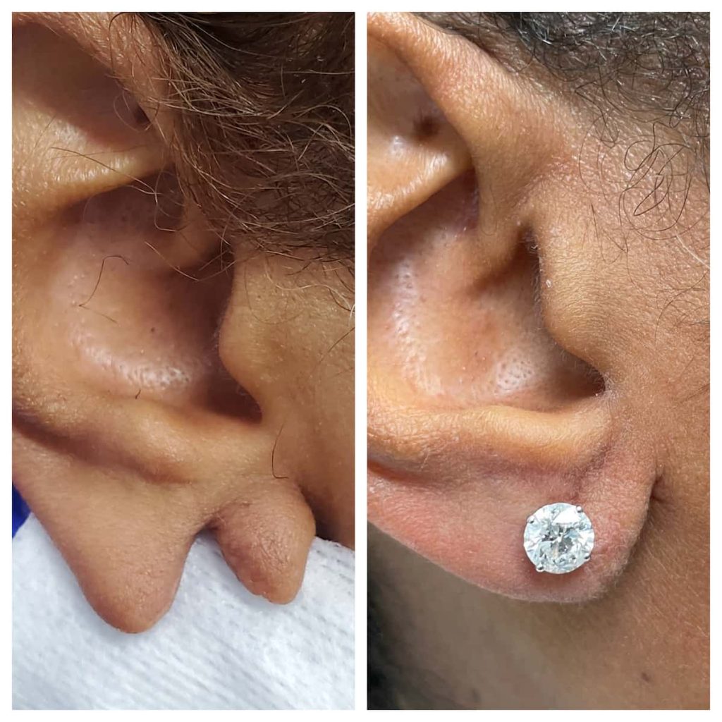 earlobe-repair