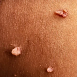 skin-tag-removal-1
