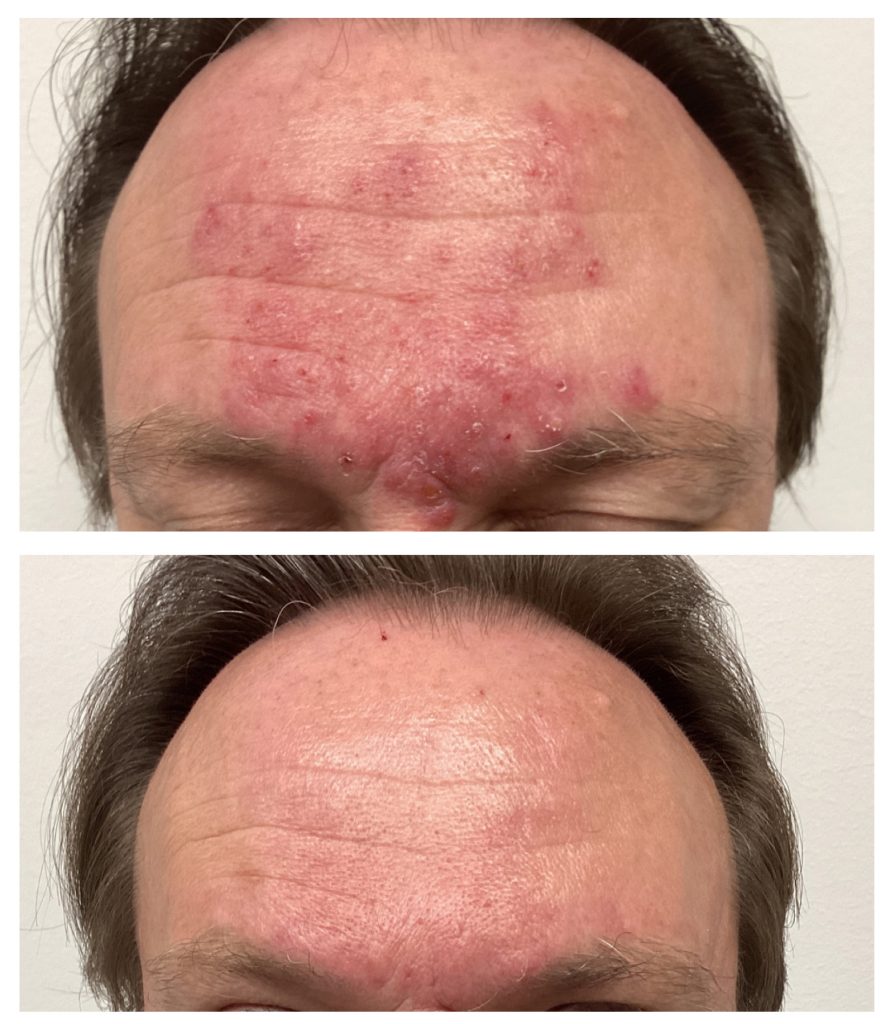 Acne-Rosacea2-895x1024