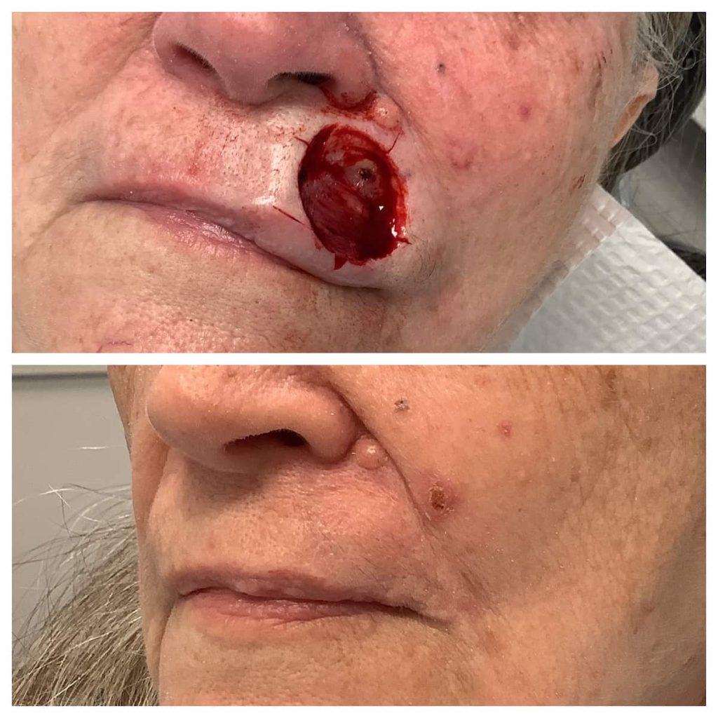 Lip-Reconstruction-before-and-after