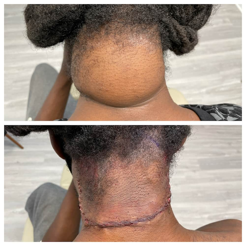 Lipoma-before-and-after-on-the-neck