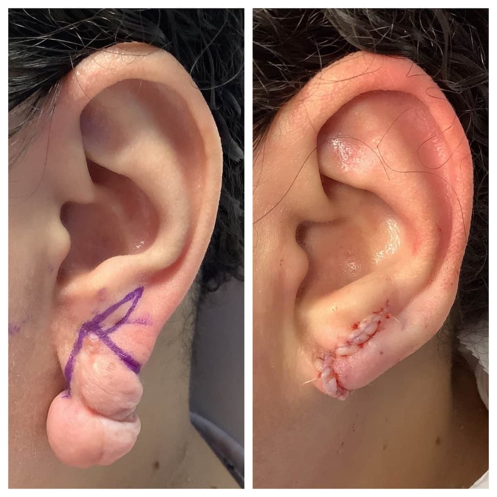 ear-surgery-before-and-after-1