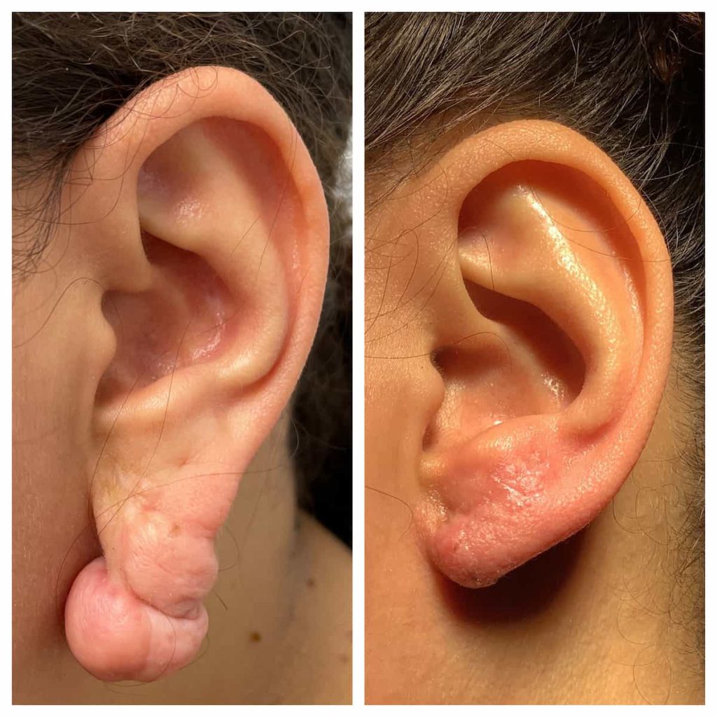 ear-surgery-before-and-after-2