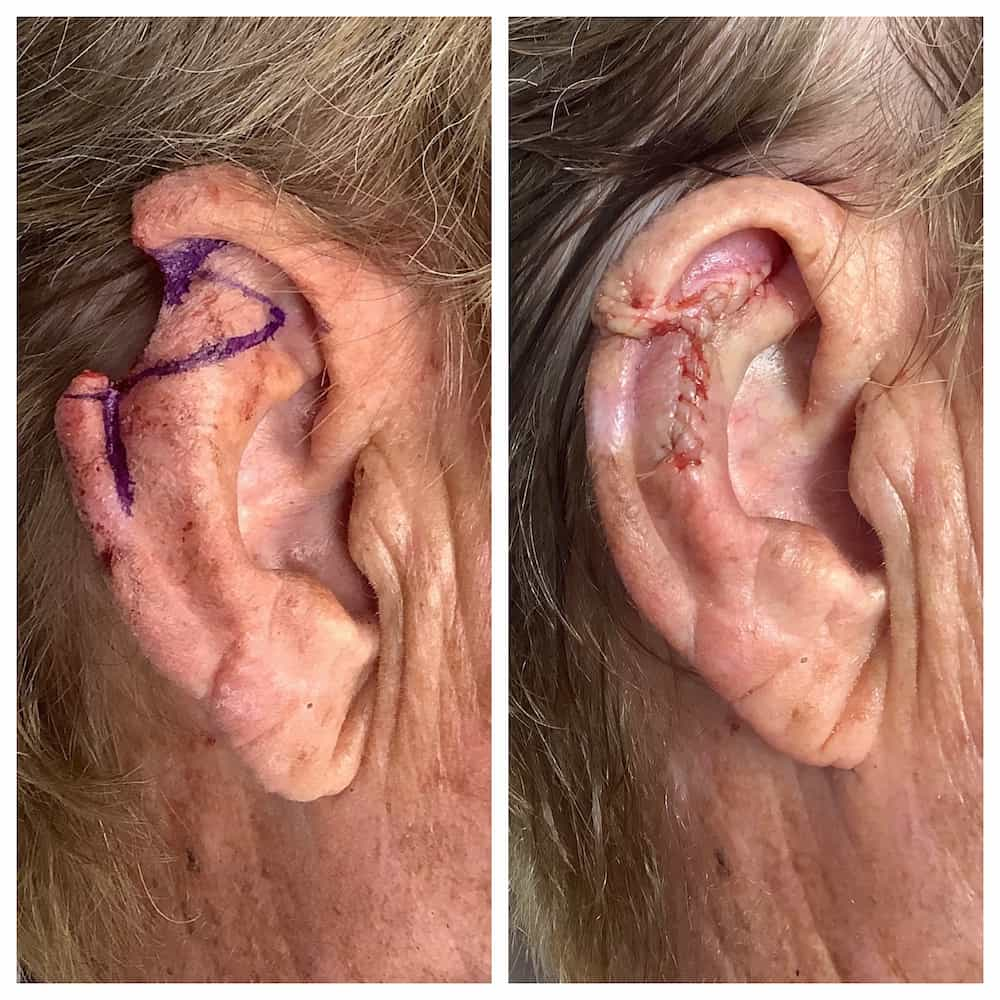 ear-surgery-before-and-after-3