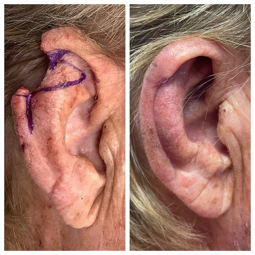 ear-surgery-before-and-after-4