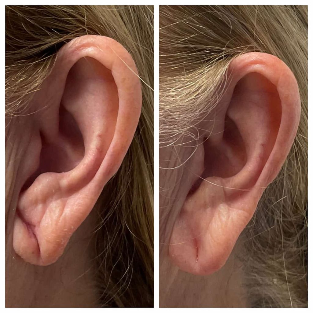 earlobe-filler-st-louis