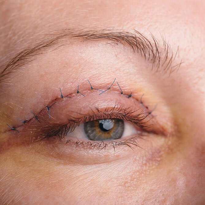 eyelid-surgery-after-sm