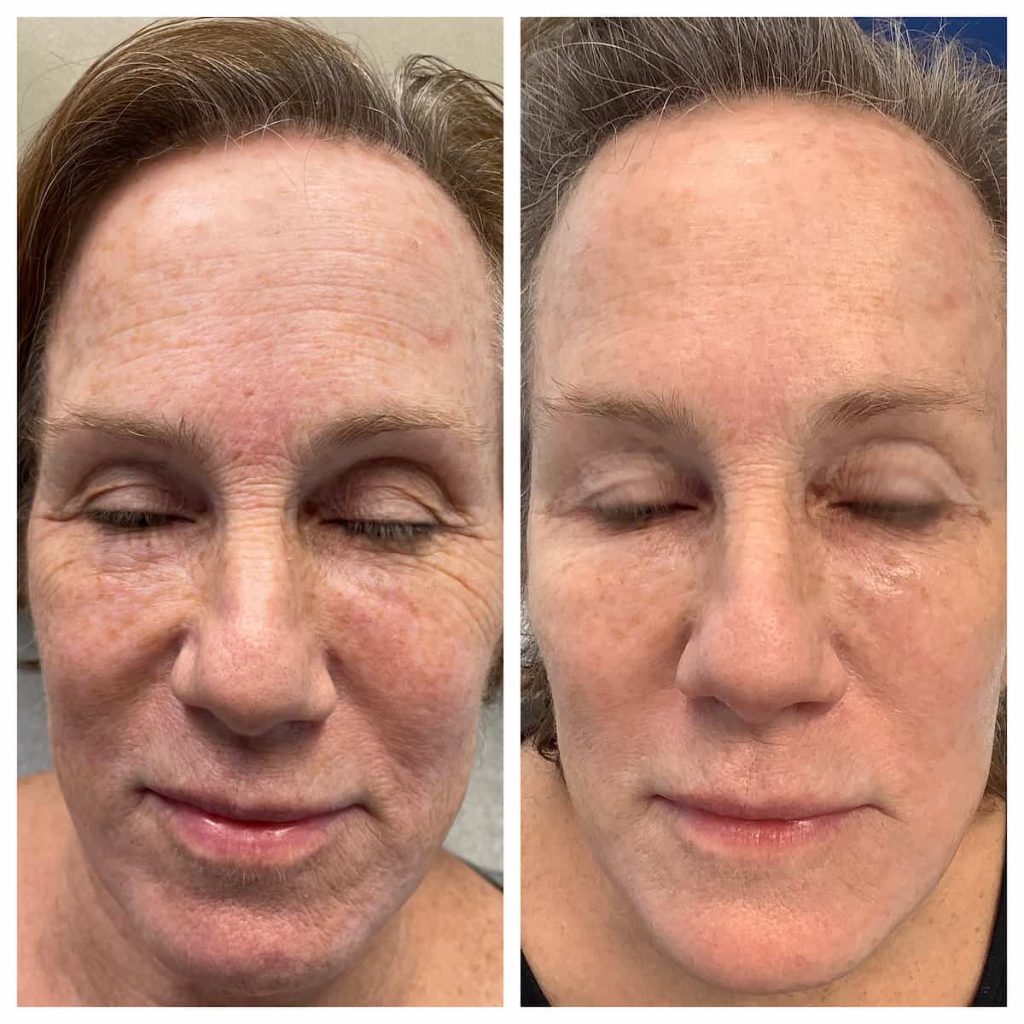 facial-rejuvenation