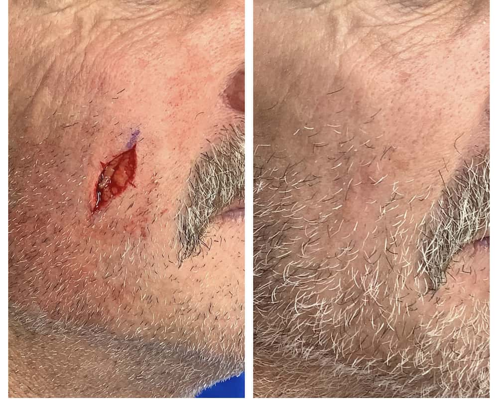 mohs-surgery-cheek-before-and-after