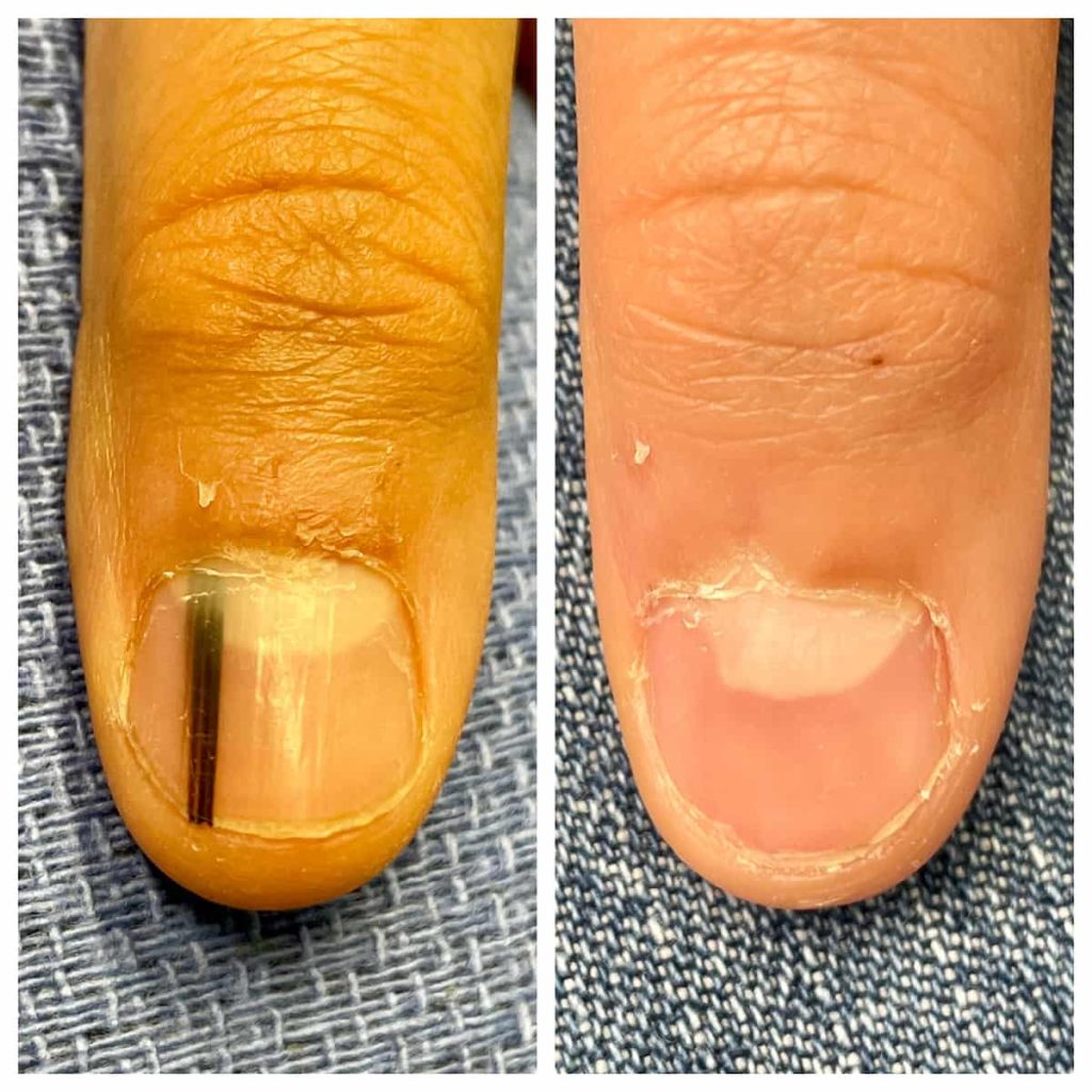 nail-surgery-1024x1024