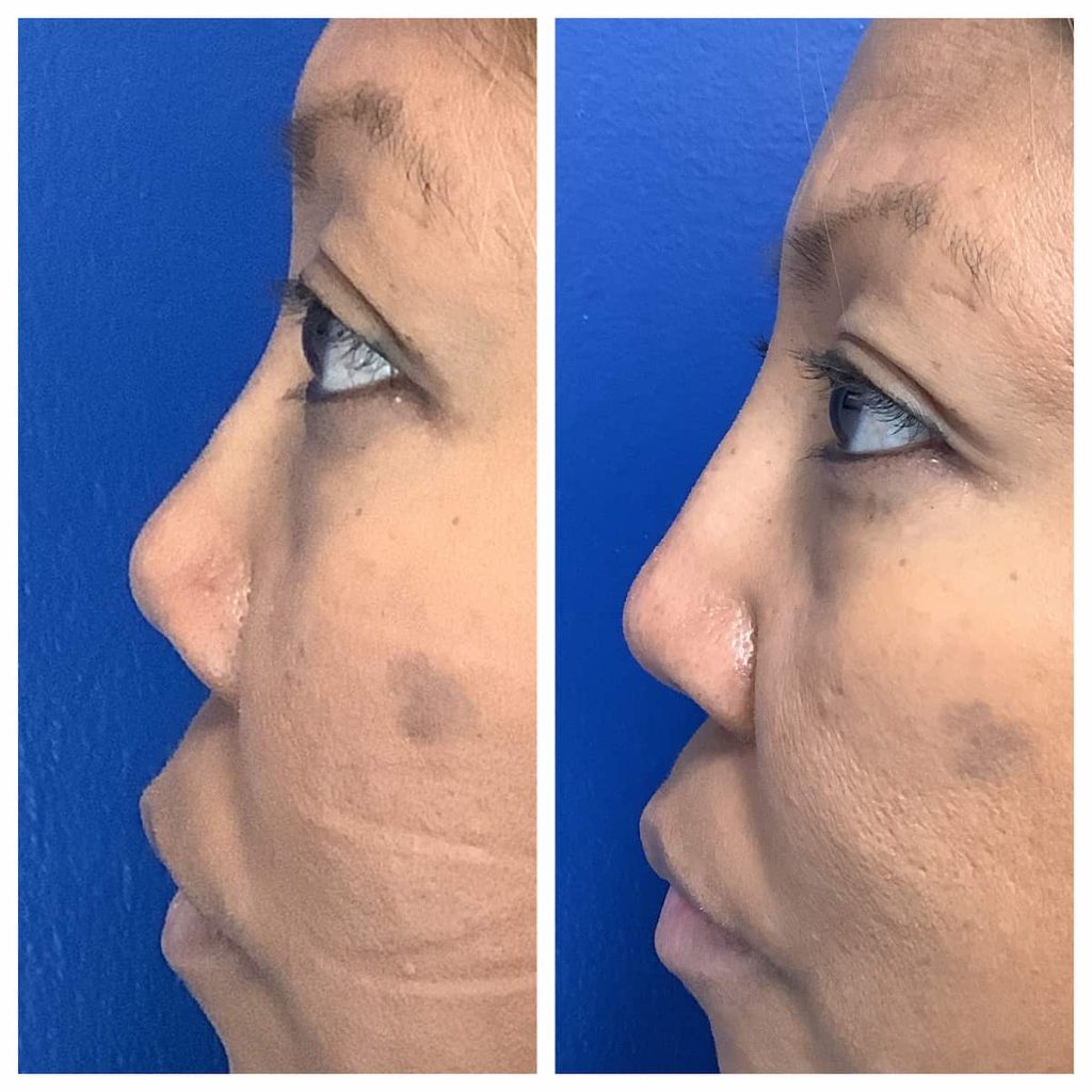 non-surgical-rhinoplasty-1