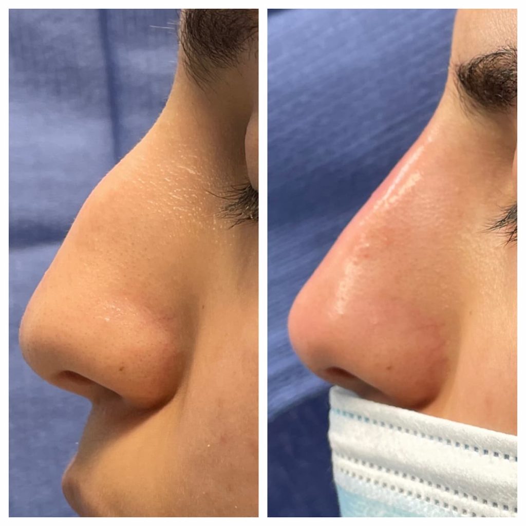 non-surgical-rhinoplasty-2