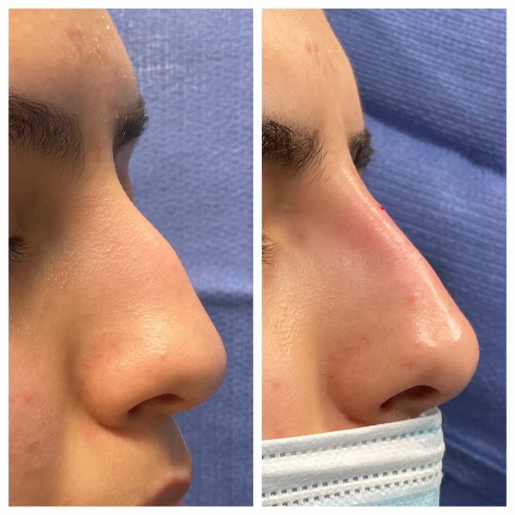 non-surgical-rhinoplasty-3