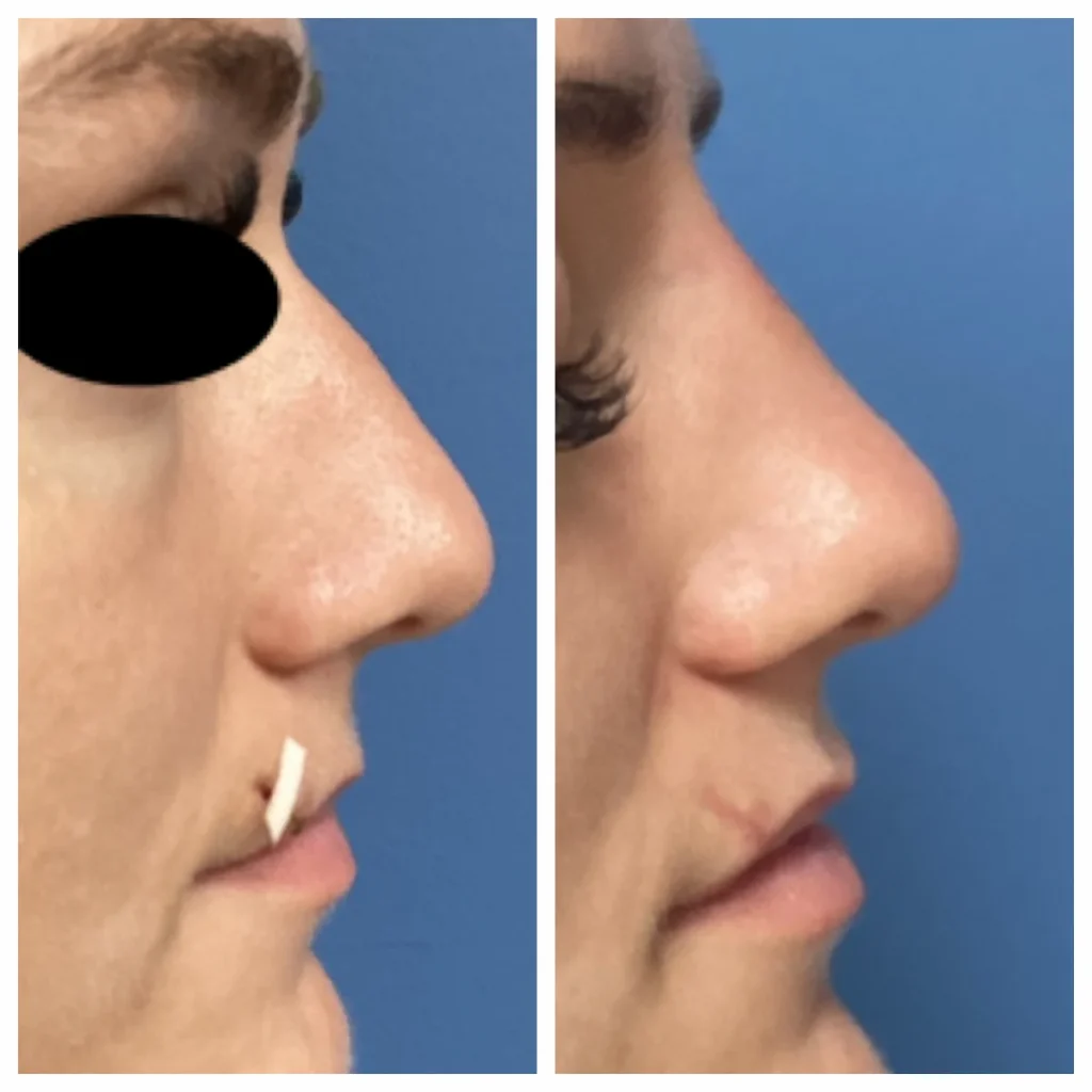 non-surgical-rhinoplasty-st-louis-2