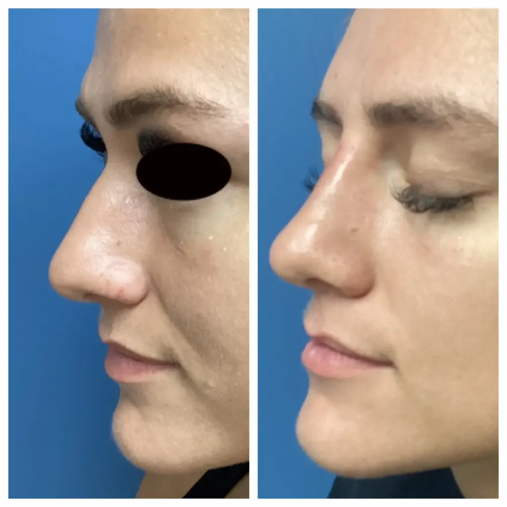 non-surgical-rhinoplasty-st-louis-3