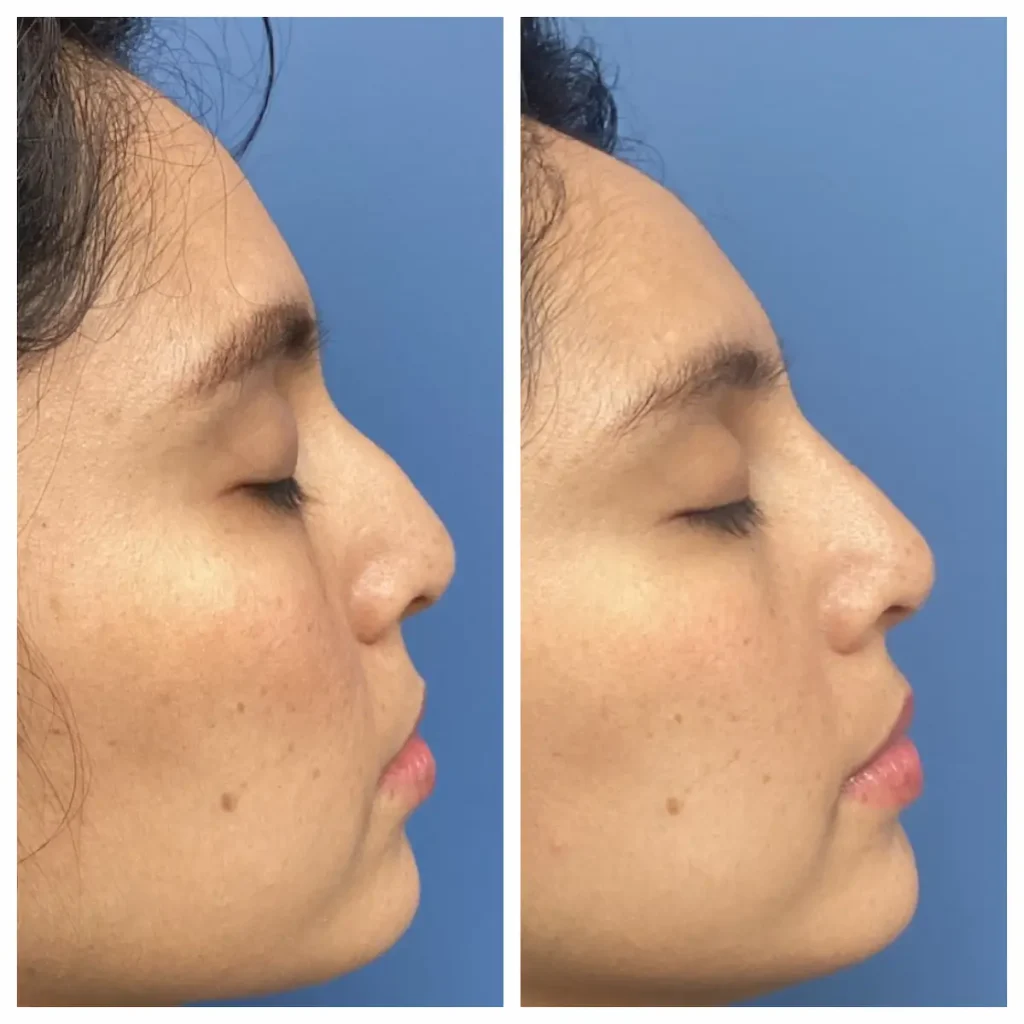 non-surgical-rhinoplasty-st-louis-4