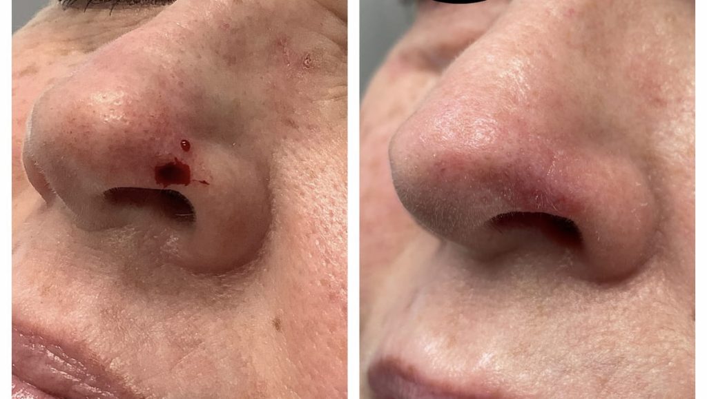 nose-surgery-before-and-after-3-1024x579