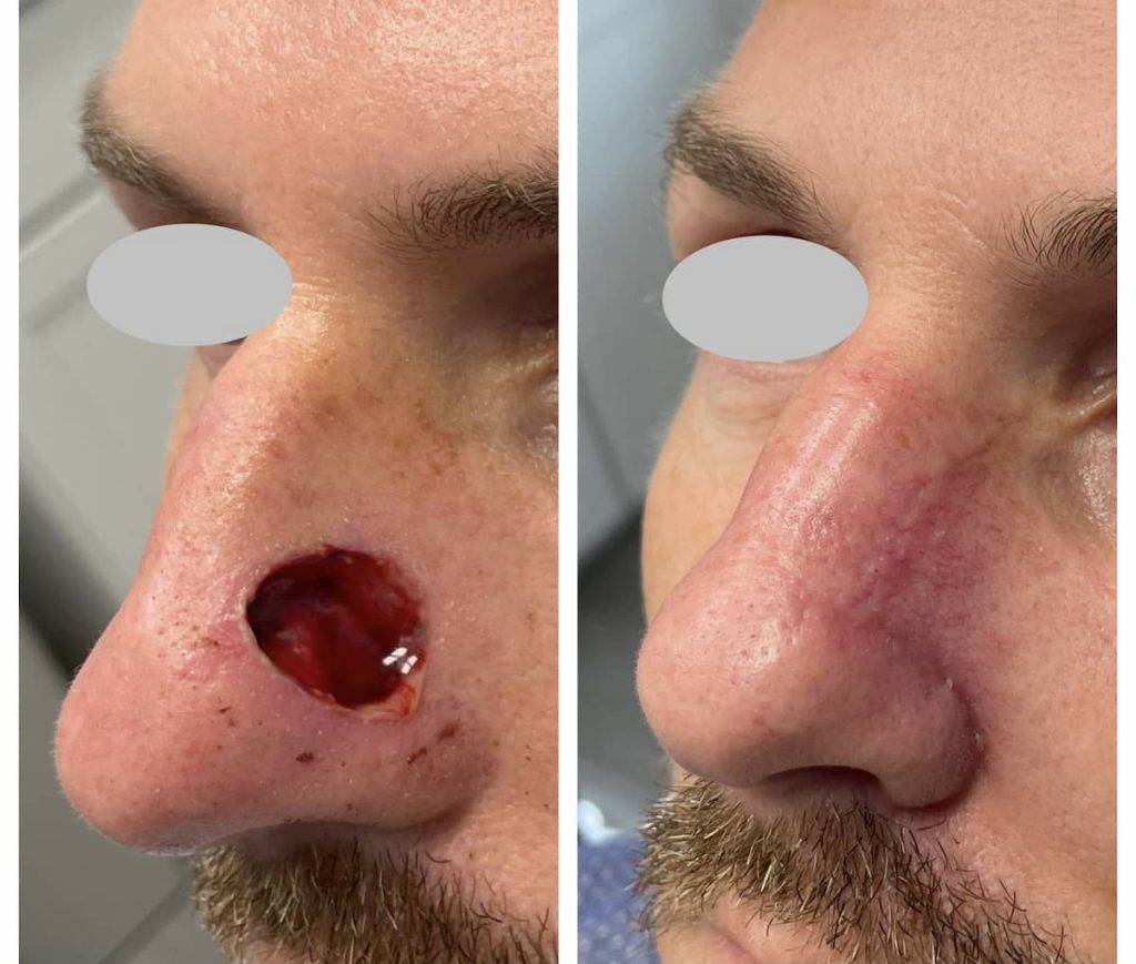 nose-surgery-before-and-after-4-1024x869