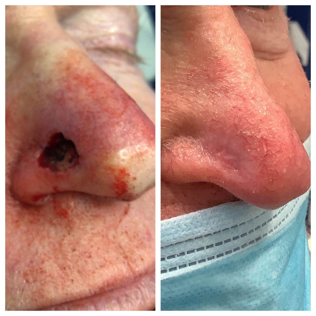 nose-surgery-before-and-after-5-1024x1024