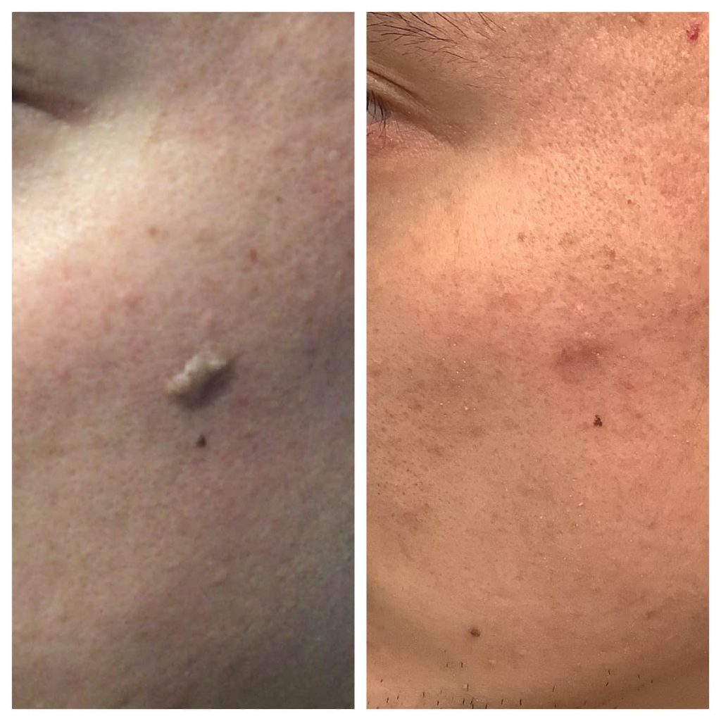 seborrheic-keratosis-removal-st-louis-1024x1024