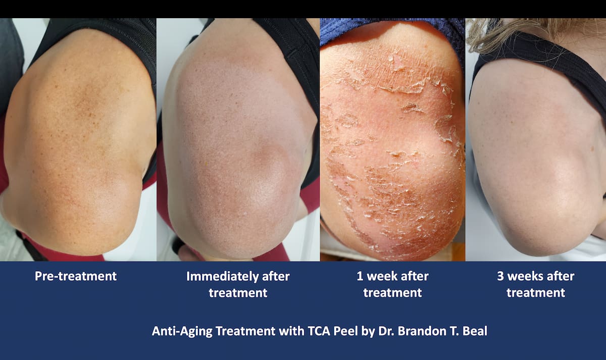 Chemical peel for sun spots before and after, patient of Dr. Brandon T. Beal