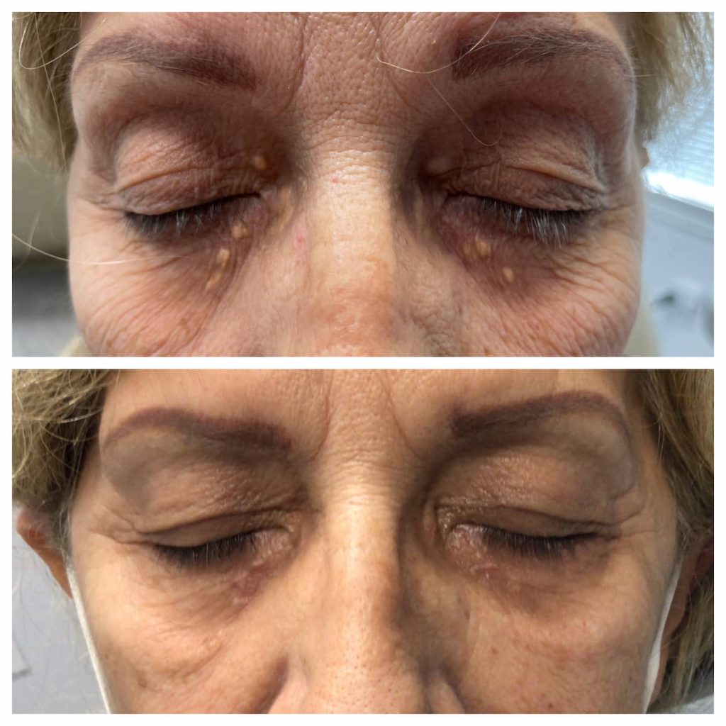 xanthelasma-treatment-2