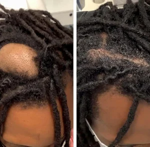 Cyst-on-scalp-before-and-after