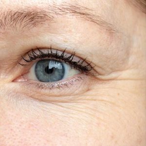 crows-feet-treatment-jacksonville