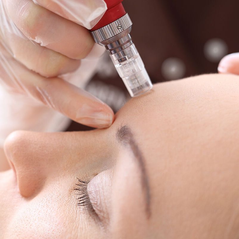 microneedling-jacksonville