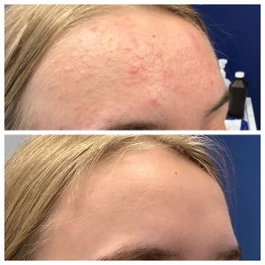 Forehead-Acne-Cure-STL