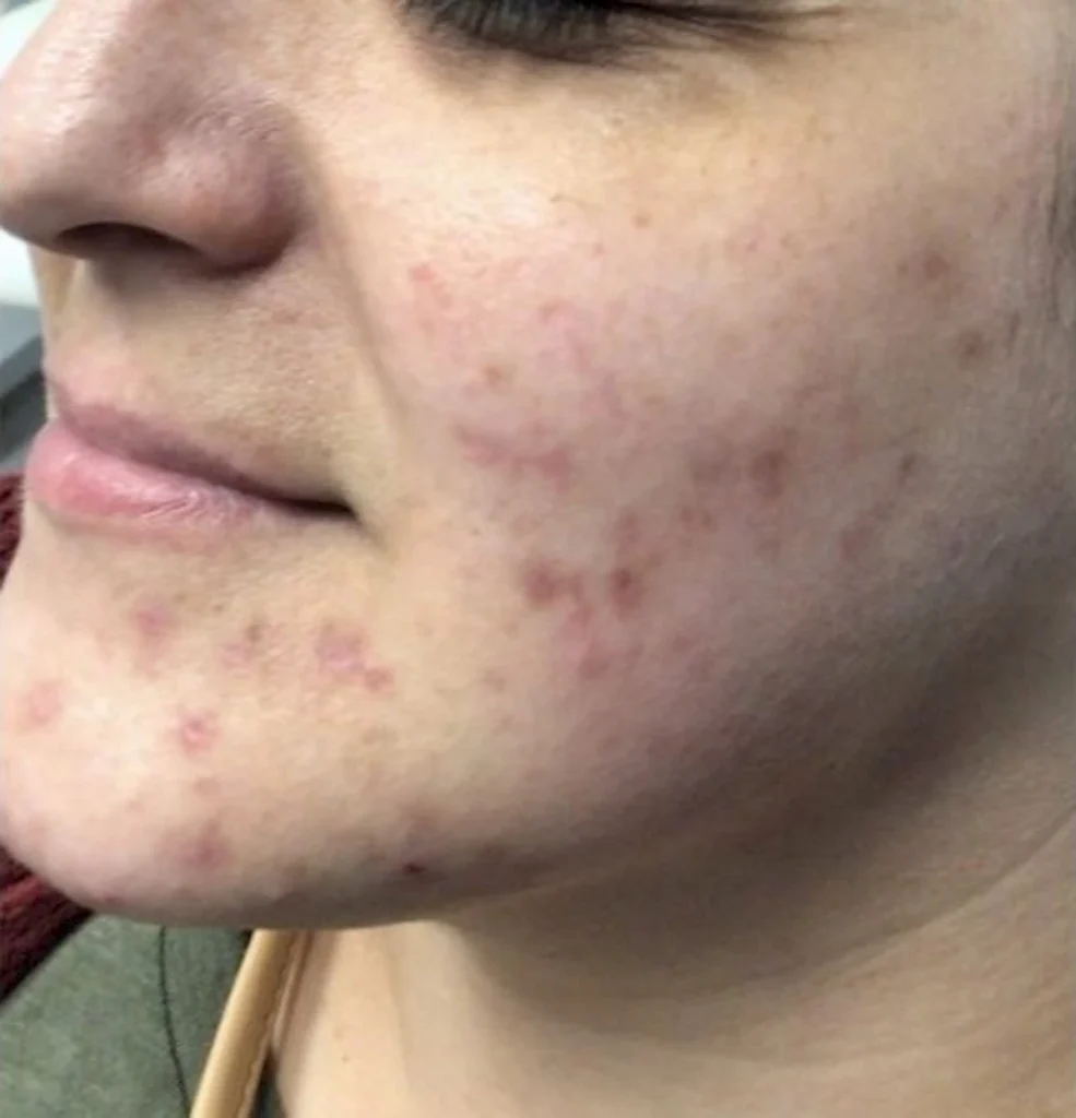 cheek-acne-treatment-before
