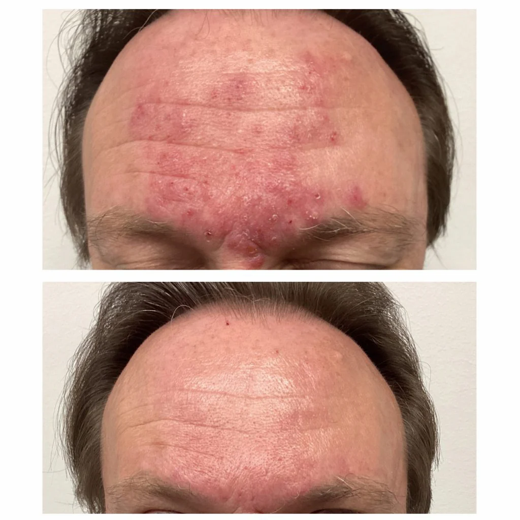 rosacea-treatment-jacksonville rosacea-treatment-jacksonville