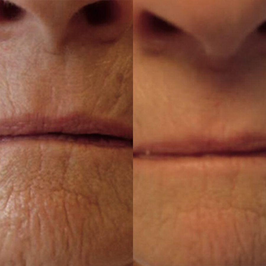 microneedling-before-and-after-jacksonville