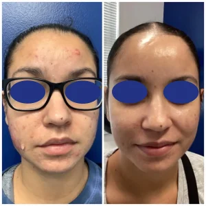 Acne before and after treatment results, patient of Dr. Brandon T. Beal