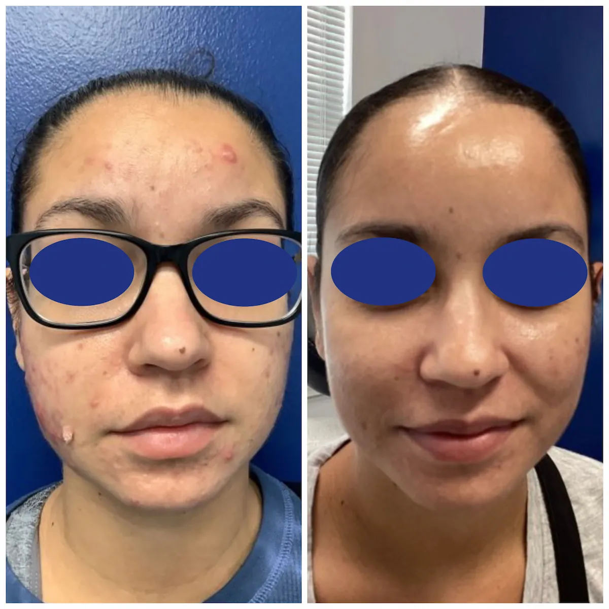 Acne before and after treatment results, patient of Dr. Brandon T. Beal