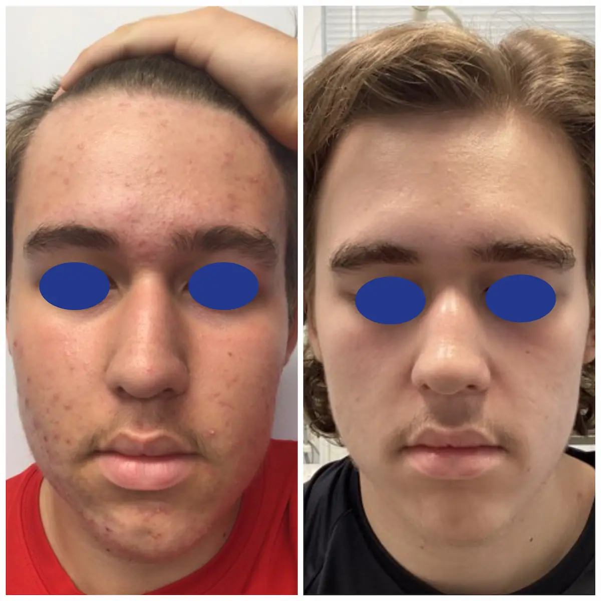 Teen acne before and after treatment results, patient of Dr. Brandon T. Beal