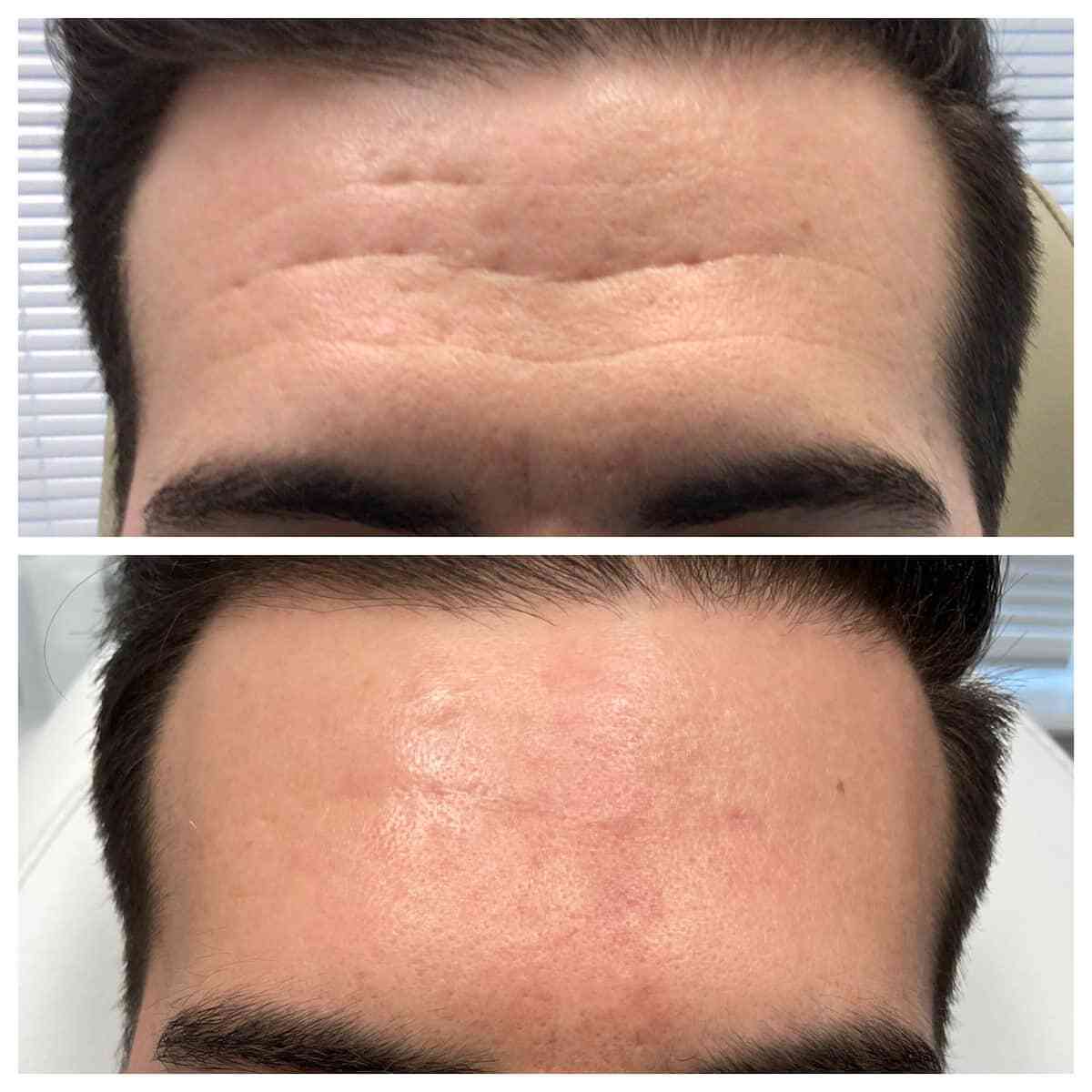 Forehead wrinkles before and after neuromodulator treatment, patient of Dr. Brandon T. Beal